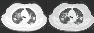 CT snimak stadija brzog napredovanja bolesti