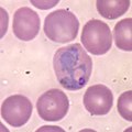 Large, amoeboid trophozoites of P. vivax in a thin blood smear