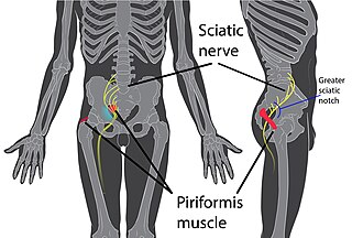 <span class="mw-page-title-main">Piriformis syndrome</span> Medical condition