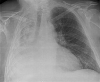 <span class="mw-page-title-main">Atelectasis</span> Partial collapse of a lung causing reduced gas exchange