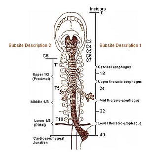 <span class="mw-page-title-main">Acute esophageal necrosis</span> Medical condition