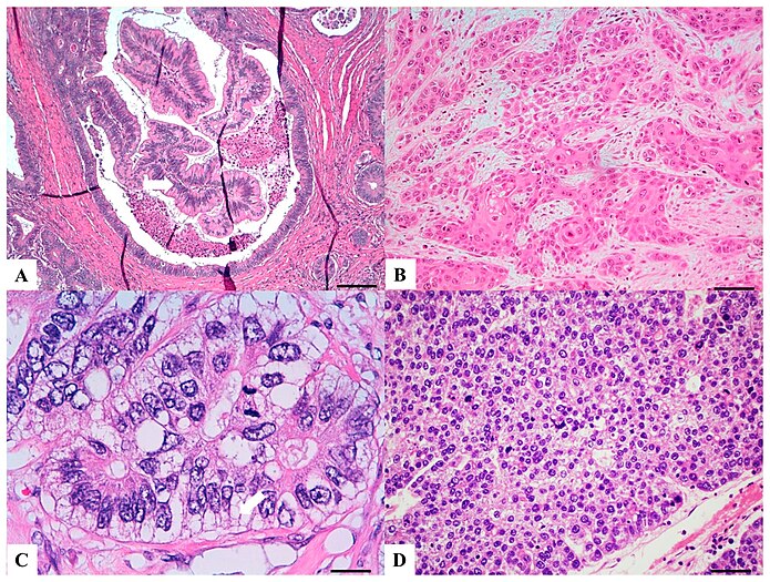 H&E stained sections: (A) Villous carcinoma: invasive carcinoma with villous features consisting of usually intraglandular papillary projections (yellow arrow) associated with an expansile growth pattern, at the deep portions of the tumor. (B) Squamous carcinoma: morphologically similar to other squamous cell carcinomas occurring in other organs with possible keratinization. (C) Clear cell carcinoma: clear cell cytoplasm identified in polygonal cells with a central nucleus, columnar cells with an eccentric nucleus (red arrow) and/or round/oval cells with abundant cytoplasm and inconspicuous marginally located nucleus similar to lipocytes or lipoblasts. (D) Hepatoid carcinoma: large polygonal-shaped cells, with granular eosinophilic cytoplasm, prominent nucleoli and trabecular and pseudo-acinar growth pattern similar to hepatocarcinoma.[9]