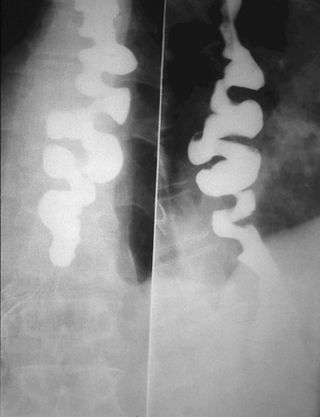 <span class="mw-page-title-main">Diffuse esophageal spasm</span> Medical condition