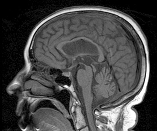 <span class="mw-page-title-main">Progressive supranuclear palsy</span> Medical condition