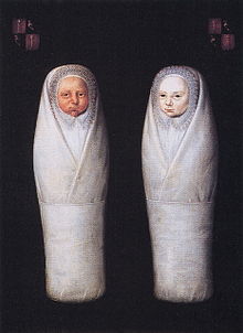 De Wikkelkinderen (The Swaddled Children), 1617, by an unknown artist, is thought to depict TTTS. De Wikkellkinderen.jpeg