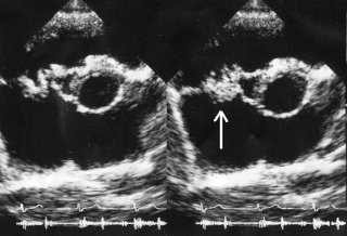 <span class="mw-page-title-main">Subacute bacterial endocarditis</span> Medical condition