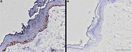 Skin biopsies of non-white (left) and white horses. Blue staining identifies Kit protein activity, while melanin is visible in the non-white sample as brown granules. The sample from the white horse shows reduced Kit activity, no melanocytes, and no melanin. DominantWhiteHorsesGH.jpg