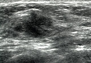 <span class="mw-page-title-main">Breast ultrasound</span> Type of medical imaging