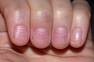 Muehrckes nails Medical condition