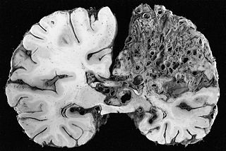 <span class="mw-page-title-main">Cerebral arteriovenous malformation</span> Medical condition