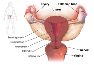 <span class="mw-page-title-main">Pelvic inflammatory disease</span> Infection of uterus, fallopian tubes, ovaries or the inner surface of pelvis