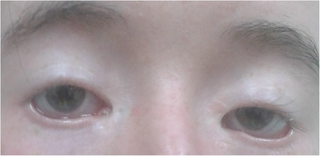 <span class="mw-page-title-main">Blepharophimosis</span> Congenital anomaly in which the eye openings are small