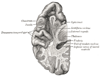 <span class="mw-page-title-main">Transverse temporal gyrus</span> Gyrus of the primary auditory cortex of the brain