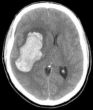 <span class="mw-page-title-main">Hypertensive emergency</span> Very high blood pressure and signs of organ damage