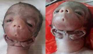 <span class="mw-page-title-main">Otocephaly</span> Congenital first branchial arch defect