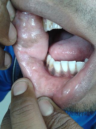 <span class="mw-page-title-main">Smoker's melanosis</span> Medical condition