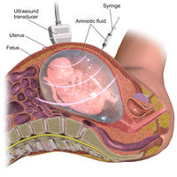 Amniocentesis Amniocentesis.png