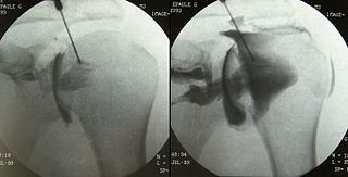 <span class="mw-page-title-main">Arthrogram</span>