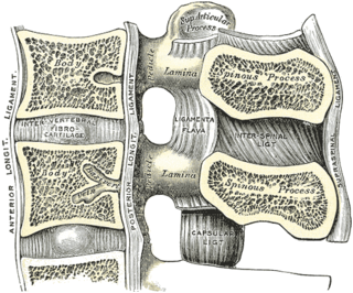 <span class="mw-page-title-main">Discectomy</span> Surgical removal of an intervertebral disc