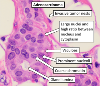 <span class="mw-page-title-main">Adenocarcinoma</span> Medical condition