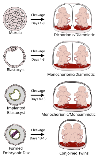 <span class="mw-page-title-main">Monoamniotic twins</span> Identical twins sharing the same amniotic sac in the womb