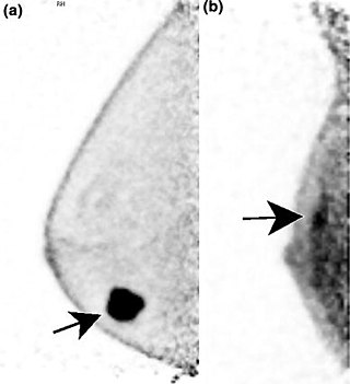 <span class="mw-page-title-main">Positron emission mammography</span> Imaging procedure used to detect breast cancer