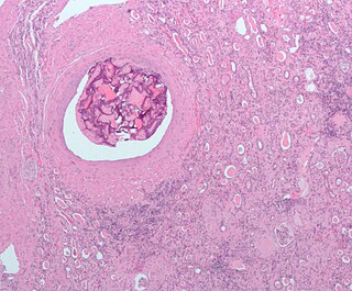 <span class="mw-page-title-main">Embolism</span> Disease of arteries, arterioles and capillaries