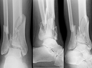 <span class="mw-page-title-main">Pilon fracture</span> Medical condition