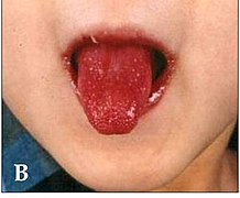 September 4: red tongue and cracked lips as symptoms of Kawasaki disease