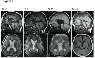 <span class="mw-page-title-main">Megalencephaly</span> Medical condition