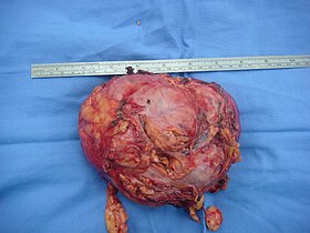 Adrenal Tumor.JPG