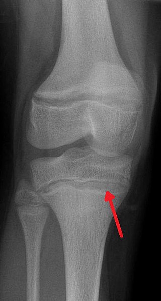 <span class="mw-page-title-main">Lead poisoning</span> Poisoning caused by lead in the body