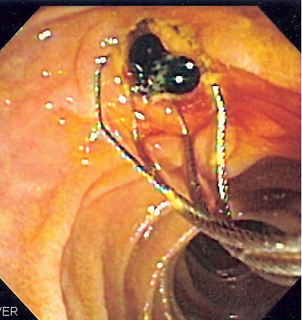 Biliary endoscopic sphincterotomy Use of endoscopy and fluoroscopy to treat and diagnose digestive issues.