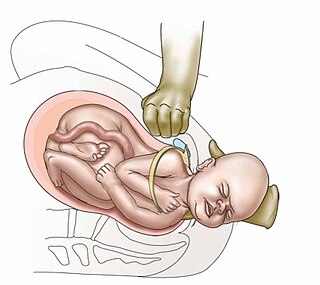 <span class="mw-page-title-main">Shoulder dystocia</span> Birthing obstruction complication