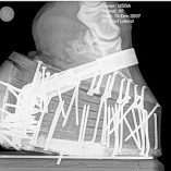 An X-ray of a horse's hoof, attached to a thick set of pads filled with nails