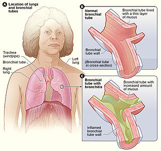 <span class="mw-page-title-main">Acute bronchitis</span> Medical condition