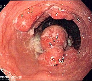 <span class="mw-page-title-main">Esophageal cancer</span> Gastrointestinal system cancer that is located in the esophagus