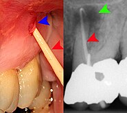 Gutta-percha point indicating abscess origin