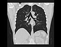 COR-2-STND-CHEST-LUNGS.jpg