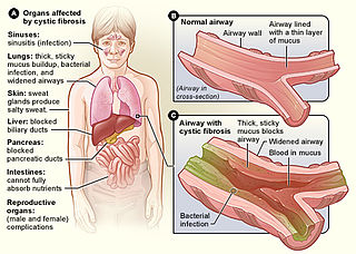 <span class="mw-page-title-main">Cystic fibrosis</span> Autosomal recessive disease mostly affecting the lungs