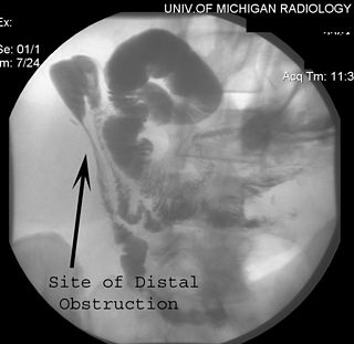 <span class="mw-page-title-main">Gardner's syndrome</span> Medical condition