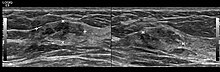 Hamartoma in breast with ultrasound Hamartoma in breast.jpg