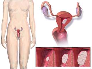 Endometrial cancer Uterine cancer that is located in tissues lining the uterus