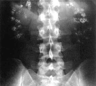 <span class="mw-page-title-main">Renal tubular acidosis</span> Higher blood acidity due to failure of the kidneys to fully acidify urine