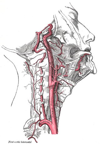 <span class="mw-page-title-main">Carotid artery dissection</span> Human disease