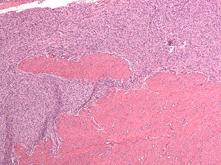 <span class="mw-page-title-main">Endometrial stromal sarcoma</span> Medical condition