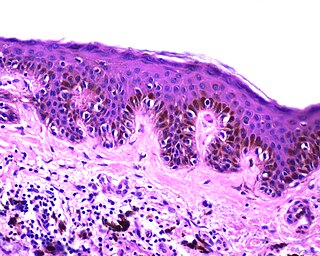 <span class="mw-page-title-main">Melanocytic nevus</span> Skin condition, mole