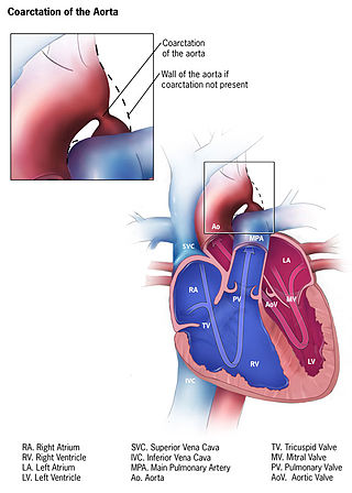 <span class="mw-page-title-main">Coarctation of the aorta</span> Heart defect of an abnormally narrow aorta