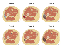 Drawings depicting the types of Morel-Lavallee lesions from the Mellando-Bencardino classification. MMLLesionClassifcation.png