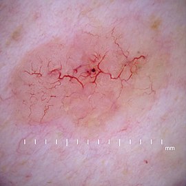 Dermoscopy showing telangiectatic vessels